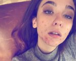 Matilda De Angelis: su Instagram la sua foto con 'il volto mangiato dall'acne'
