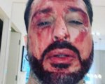 Fabrizio Corona ricoverato dopo le immagini shock su Instagram in cui era ricoperto di sangue