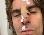 Liam Gallagher, incidente in elicottero per il cantante degli Oasis: la foto del volto tumefatto