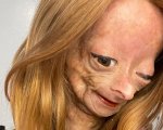 Adalia Rose Williams: morta la star di Youtube, aveva 15 anni